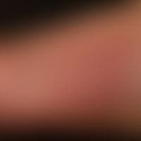Dyshidrotische Dermatitis:&nbsp;chronisch rezidivierendes gering infiltrierte, scharf begrenzte r...