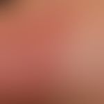 Psoriasis palmaris et plantaris: Plaque typewith dyshidrotic vesicles (detailed picture). 22-year...