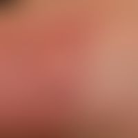Psoriasis palmaris et plantaris:&nbsp;Plaque-Typ mit dyshidrotischen Pläschen (Detailaufnahme). B...
