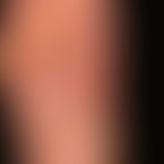 Psoriasis palmaris et plantaris: Plaque type with dyshidrotic vesicles. 22-year-old woman shows s...