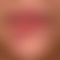 Melkersson-Rosenthal syndrome: initially variable, after a few months persistent, unilateral, red...