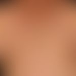 Gynaecomastia: pronouncedbilateral enlargement of the mammae in a 72-year-old male patient; marke...