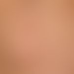 Lipoma: A subcutaneous lump which has existed for years, is completely unattractive and asymptoma...