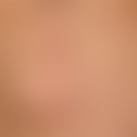 Lipoma: A subcutaneous lump which has existed for years, is completely unattractive and asymptoma...