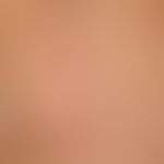 Lipoma: A subcutaneous lump (circled in white) which has existed for years, is completely unattra...