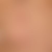 Lipoma: A subcutaneous lump (circled in white) which has existed for years, is completely unattra...
