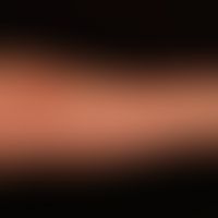 Koebner phenomenon - Eruptive xanthomes: Linear arrangement of reddish-brown papules as an expres...