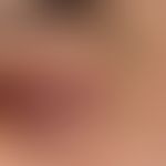Mycosis fungoides tumor stage: long term known Mycosis fungoides. recurrent plaques and nodules, ...