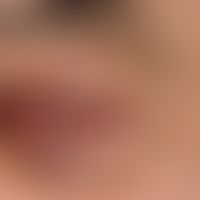 Mycosis fungoides Tumor-Stadium:&nbsp;langzeitig bekannte Mycosis fungoides. Immer wieder auftret...