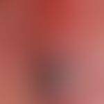 Melanom malignes, amelanotisches: seit Jahren bestehender rötlicher Knoten, der vor&nbsp; einigen...