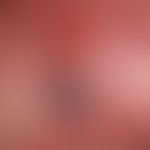 Melanom malignes, amelanotisches: Übersicht. Seit Jahren bestehender rötlicher Knoten, der vor&nb...