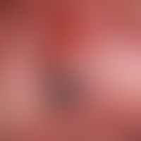 Melanoma malignes, amelanotic: Overview. reddish lump which has existed for years and bled for th...