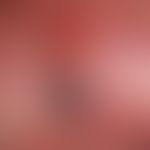 Melanom malignes, amelanotisches: Übersicht. Seit Jahren bestehender rötlicher Knoten, der vor&nb...