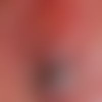 Melanoma malignes, amelanotic: a reddish, locally ulcerated lump on the capillitium that has been...