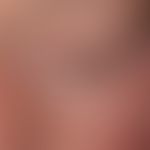 Lupus erythematosus acute-cutaneous: symmetric red spots, patches and plaques in the face, neck a...