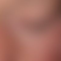 Lupus erythematosus acute-cutaneous: symmetric red spots, patches and plaques in the face, neck a...