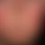 lupus erythematosus acute-cutaneous: symmetrical red spots, patches and plaques on the face, neck...