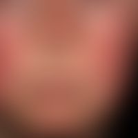 lupus erythematosus acute-cutaneous: symmetrical red spots, patches and plaques on the face, neck...