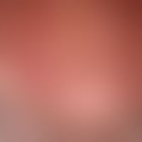 Light ageing of the skin: spotty skin with small hyperpigmentations (solar lentigines) and actini...