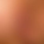 Karzinom der Haut: flächig ausgebreiteter, völlig symptomloser Knoten mit zentraler Ulkusbildung....