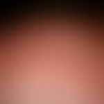 Lichtalterung der Haut: scheckige Haut mit kleinherdigen Hyperpigmentierungen (solaren Lentigines...