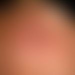 Lichtalterung der Haut: glatt atrophische Haut mit flächiger aktinischer Keratose (frontaler Bere...