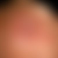 Light aging of the skin: smooth atrophic skin with flat actinic keratosis (frontal area) with tra...