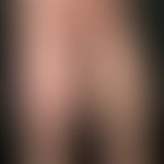 Lymphedema: one-sided, skin-coloured swelling due to insufficient transport capacity of the lymph...
