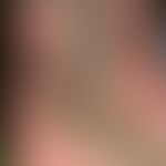 Papillomatosis cutis lymphostatica: massiver Befund mit papillomatösen Wucherungen an den Unersch...