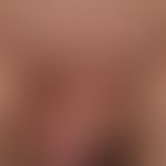 Chronic genital lymphedema ( condition following pelvic lymphadenectomy) with incipient papilloma...