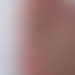 Arthritis urica: plötzlich aufgetretene spontan und auf leichten Druck schmerzhafte (Gehen nur sc...
