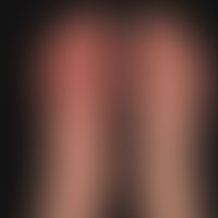 Arthritis urica beidseitig: plötzlich (über Nacht) aufgetretene sehr schmerzhafte (Gehen nur schw...