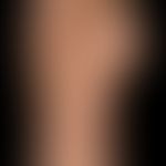 Gichttophi: nicht entzündliche Gichttophie am Großzehengrundgelenk und am Fußrücken.
