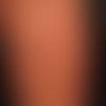 Granuloma anulare disseminatum: anular plaque. partial manifestation on the left lower leg. non-p...