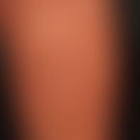Granuloma anulare disseminatum: anular plaque. partial manifestation on the left lower leg. non-p...