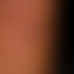 Granuloma anulare disseminatum: partial manifestation on the forearm. non-painful, non-itching, d...