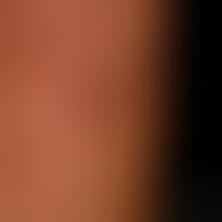 Granuloma anulare disseminatum: partial manifestation on the forearm. non-painful, non-itching, d...