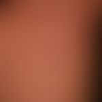 Granuloma anulare disseminatum: partial manifestation. non-painful, non-itching, disseminated, la...