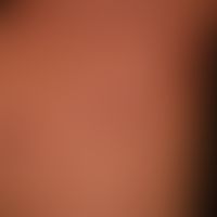 Granuloma anulare disseminatum: partial manifestation. non-painful, non-itching, disseminated, la...