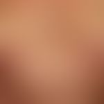 Mycosis fungoides (plaque stage): 72-year-old male (sucking plaque stage of Mycosis fungoides); m...