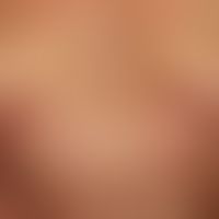 Mycosis fungoides (plaque stage): 72-year-old male (sucking plaque stage of Mycosis fungoides); m...