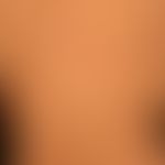 Slerodermie zirkumskripte (Typ Atrophodermia idiopathica et progressiva ): seit etwa 2-3 Jahren e...