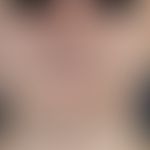 Sklerodermie zirkumskripte (Typ Parry-Romberg-Syndrom): Umschriebener, hellbrauner, zentral teils...