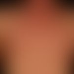 Syphilis: papulöses Syphilid. Rezidivexanthem.&nbsp; Disseminierte nicht juckende oder schmerzend...