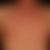 Syphilis: papular syphilide. recurrent hexanthema. disseminated non-itching or painful, 0.2-04cm ...