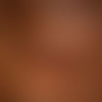 Sarcoidosis nodular form: several, for about 2 years existing, so far continuously grown, symptom...