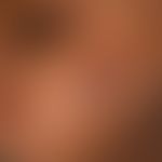 Nodules, firm, without schema. brown: Sarcoidosis nodular form; several, for about 2 years existi...
