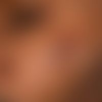 Nodules, firm, without schema. brown: Sarcoidosis nodular form; several, for about 2 years existi...