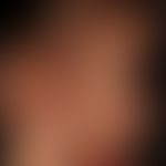 Hämangiom des Säuglings (Serie: 6 Jahre alt, komplette &nbsp;Abheilung, keine Therapie&nbsp;)
