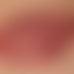 Hämangiom des Säuglings (Serie: Befund nach 1 Jahr): Keine Therapie &nbsp;
